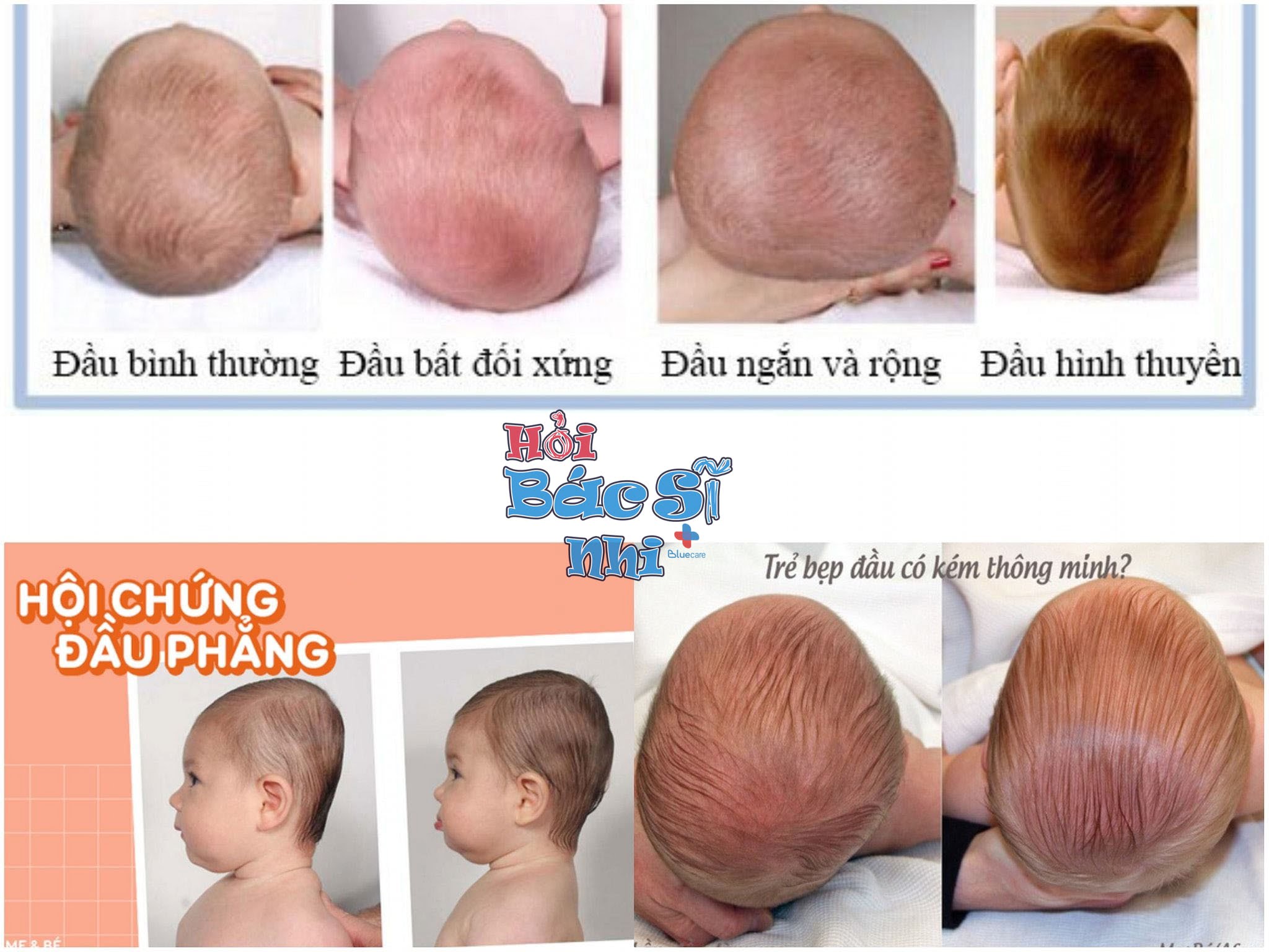 Đối với trẻ sơ sinh bị đầu bẹp, hãy cùng tìm hiểu những giải pháp hữu hiệu để giúp bé phát triển đầu hình tròn, giúp bé giảm thiểu các tác động xấu đến sức khỏe của bé nhé.