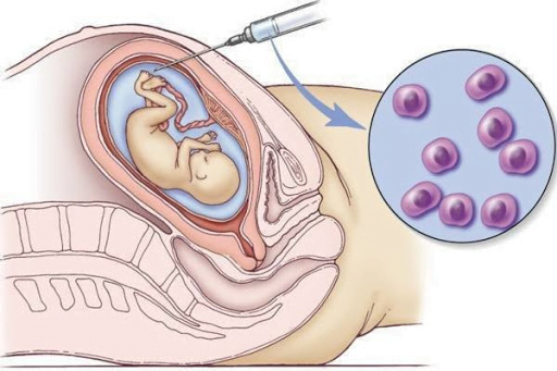 Khi có chỉ định chọc ối, mẹ bầu cần chuẩn bị gì để an toàn hơn cho mẹ và thai nhi