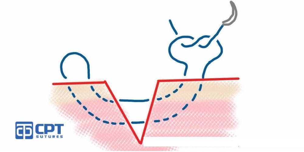 Kỹ thuật điều dưỡng: các mũi khâu vết thương cơ bản