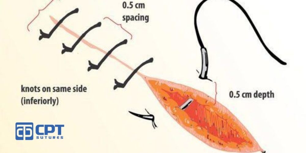 Kỹ thuật điều dưỡng: các mũi khâu vết thương cơ bản