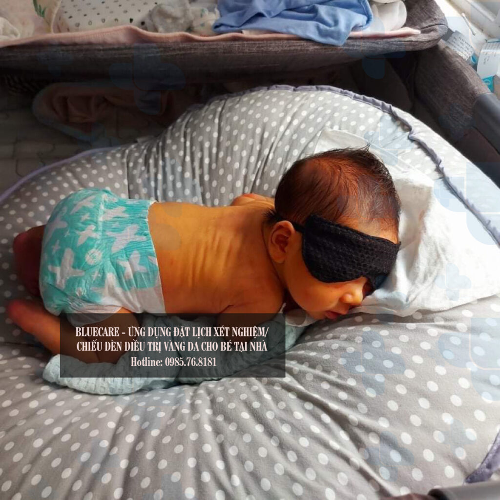 Chiếu đèn cho trẻ vàng da không có hại nếu em bé được băng mắt và mặc bỉm.