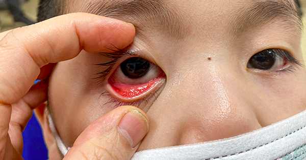 Trẻ bị viêm kết mạc mắt do Adeno Virus