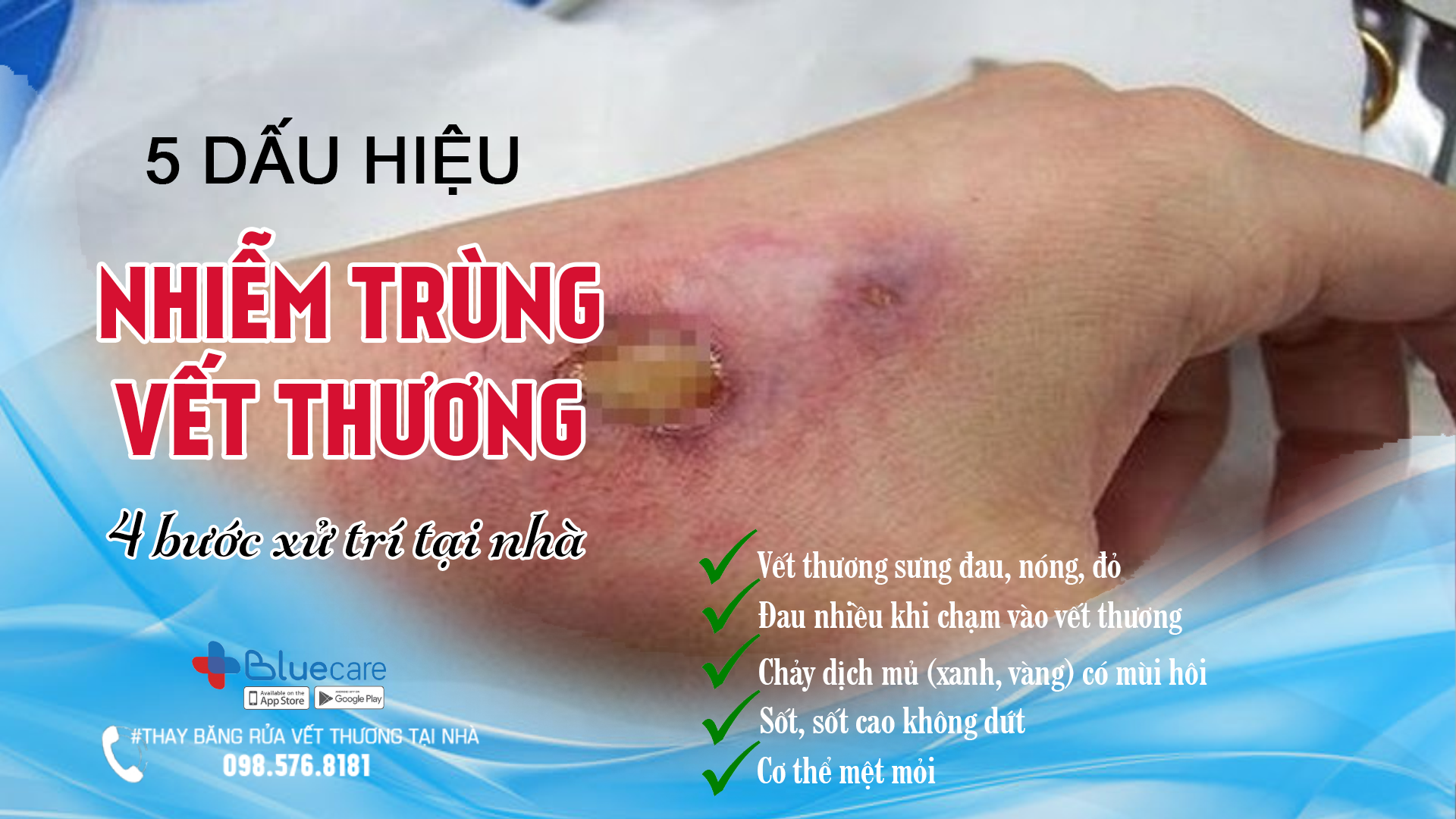 5 Dấu Hiệu Nhiễm Trùng Vết Thương Tại Nhà And 4 Bước Xử Trí Bluecare Blog 8513